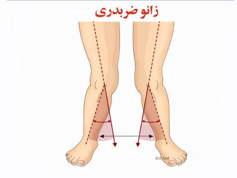 زانوی ضربدری