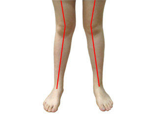 ناهمجاری زانوی خم