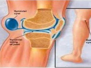 ورم زانو، تشخیص و درمان
