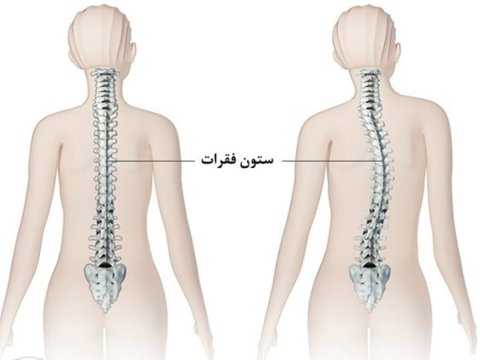 اسکولیوز