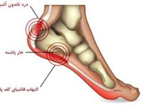 درمان فیزیوتراپی خار پاشنه
