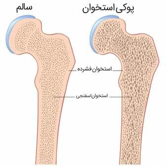 پوکی استخوان