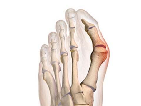 ناهنجاری شست کج