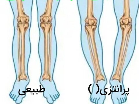 زانوی پرانتزی