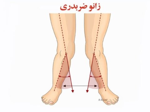زانوی ضربدری