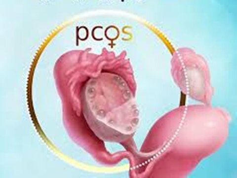 ورزش و کیست های تخمدان