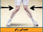 آشنایی با ناهنجاری زانوی خمیده