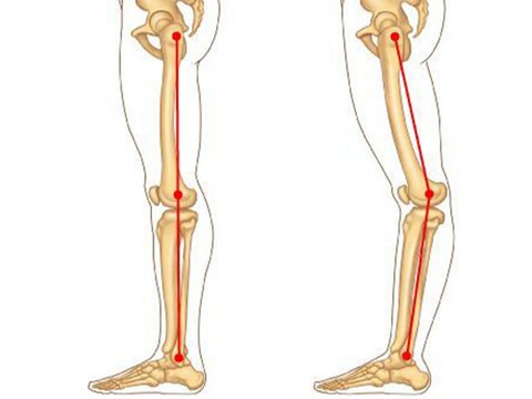 زانوی عقب رفته