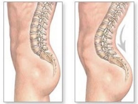 ناهنجاری کمر گود