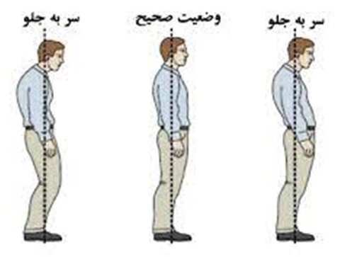 عارضه گردن رو به جلو و اصلا ح آن