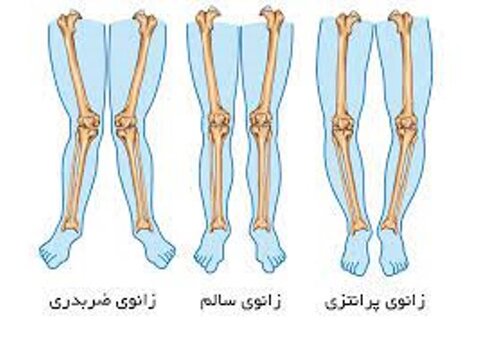 پای پرانتزی بزرگسالان و درمان آن با ورزش