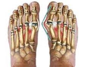 شست کج پا و درمان آن با  ورزش های حرکت اصلاحی