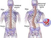 حرکات اصلاحی برای اسکولیوز در مادران