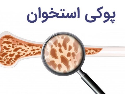 پوکی-استخوان-1.jpg