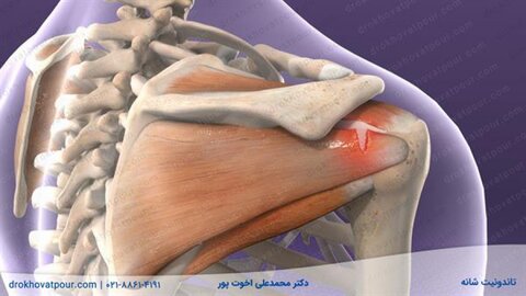 درمان التهاب