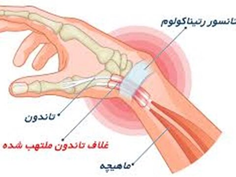 حرکات اصلاحی برای سندروم دکرون