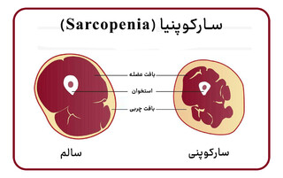 Sarcopenia