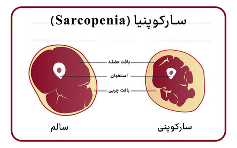 Sarcopenia
