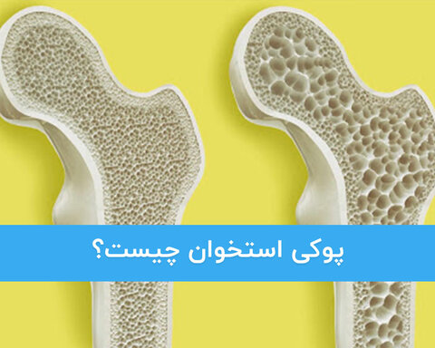 پوکی استخوان