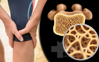 پوکی استخوان