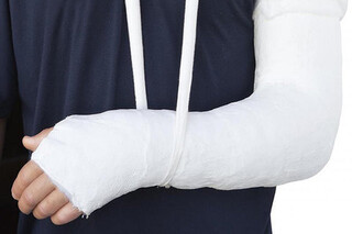 شکستگی بازو