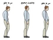 ناهنجاری سر به جلو