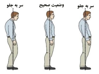 ناهنجاری سر به جلو