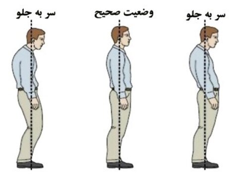 ناهنجاری سر به جلو