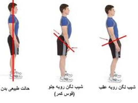 ناهنجاری کمر گود یا لوردوزیس