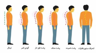 ناهنجاری گرد پشتی یا کایفوزیس و عوارض آن