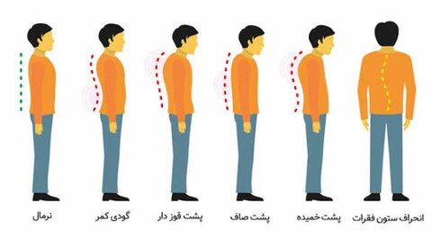 ناهنجاری گرد پشتی یا کایفوزیس و عوارض آن